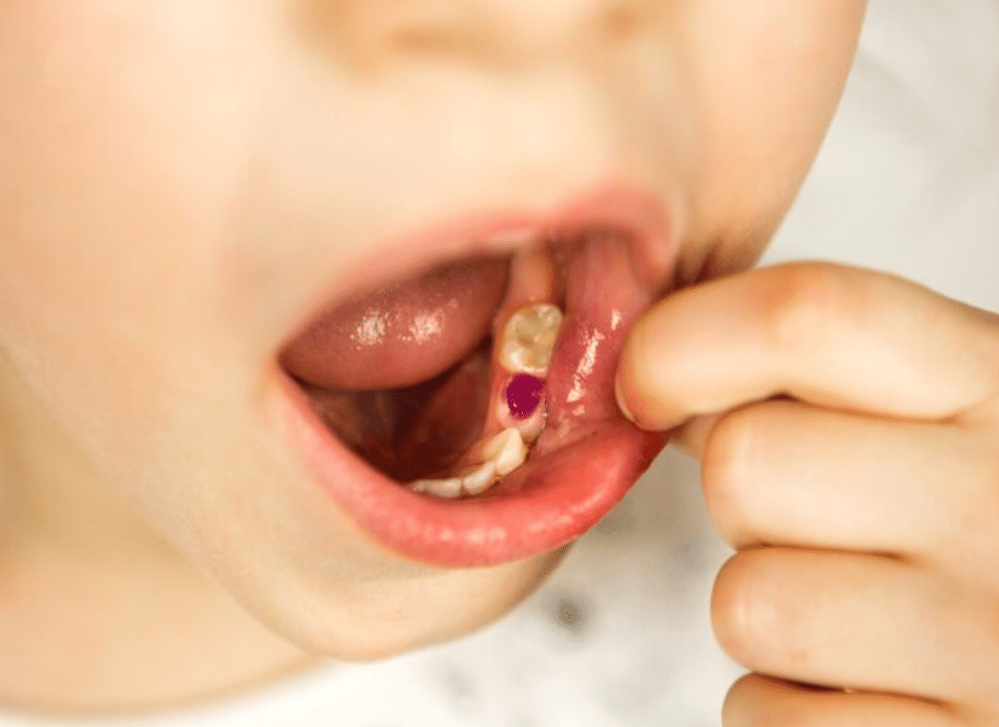 Você sabe o que é Hipomineralização Molar Incisivo (HMI)?